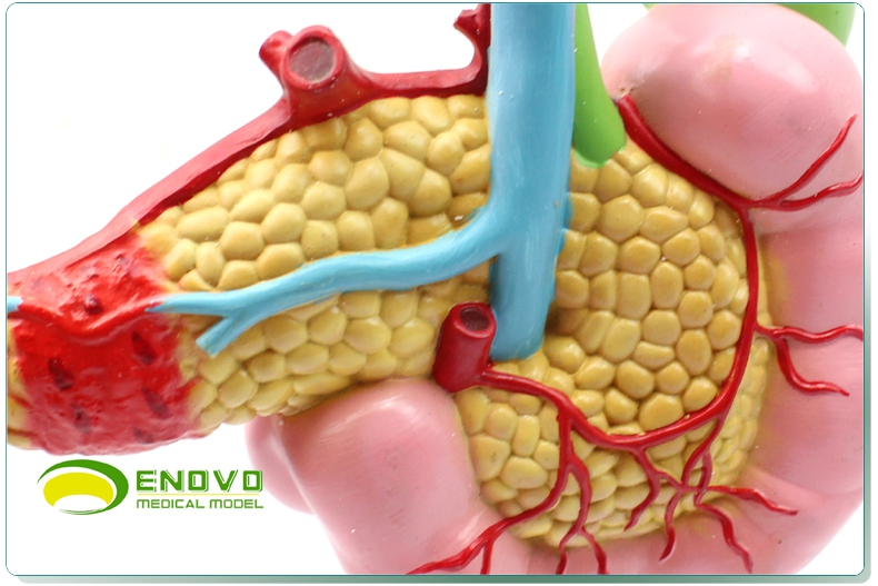 enovo頤諾醫學胰腺十二指腸膽囊病理模型膽結石外科消化系統模型